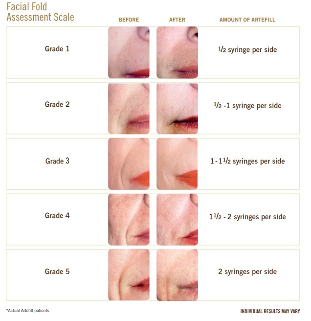 What is the average cost of ArteFill treatment?