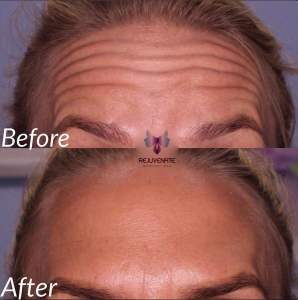 botox before and after