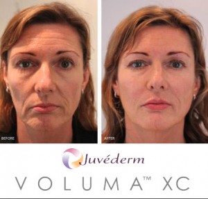 juvederm voluma before and after pictures