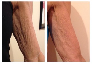 Upper Arm Tightening In Los Angeles - Skin Treatment in LA