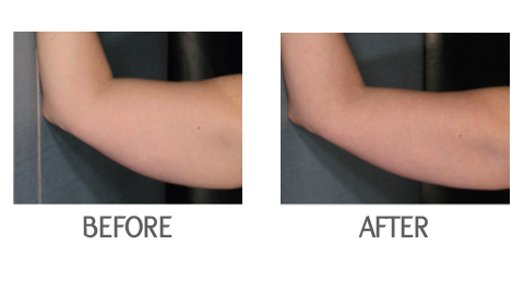 Get Rid of Arm Fat VELASHAPE  Non-surgical fat removal LasVegas