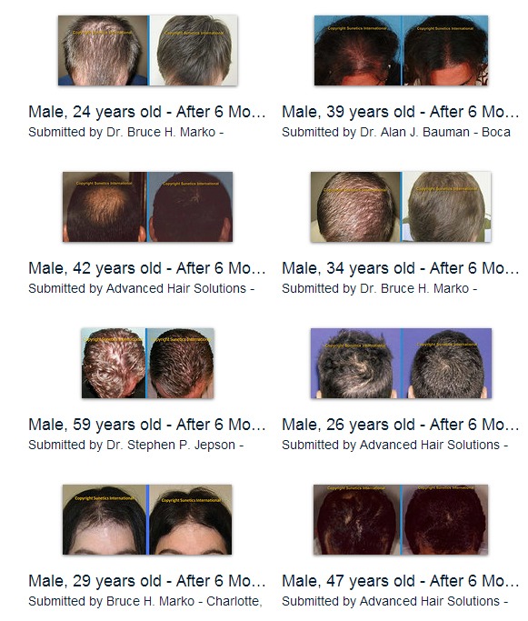 Hair loss_Laser Hair restoration Cost before and after pictures