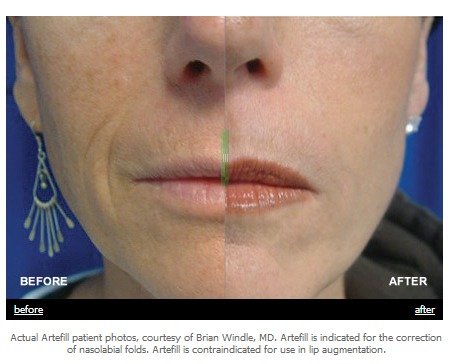 Artefill Wrinkle Treatment - Reduce Wrinkles and Aging before and after photos