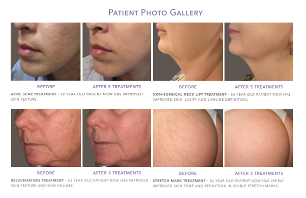 Wrinkle Reduction With The NEW RF Microneedling - Los Angeles