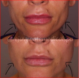 How long does Bellafill Dermal Filler last? | Los Angeles Medical Spa