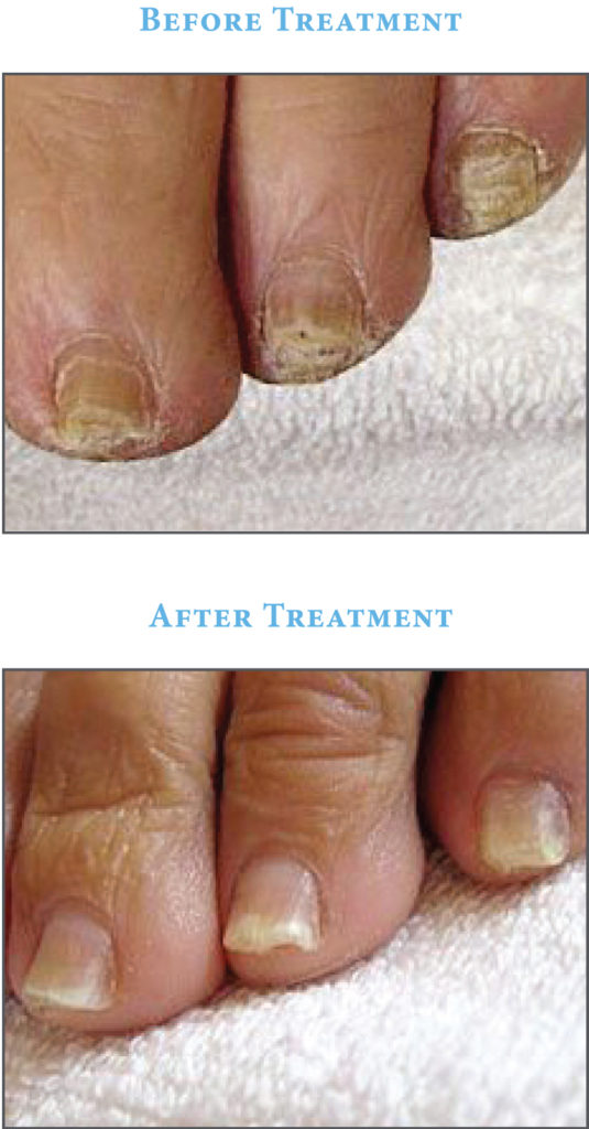ClearSteps  Laser Onychomycosis (nail infection) before after photots