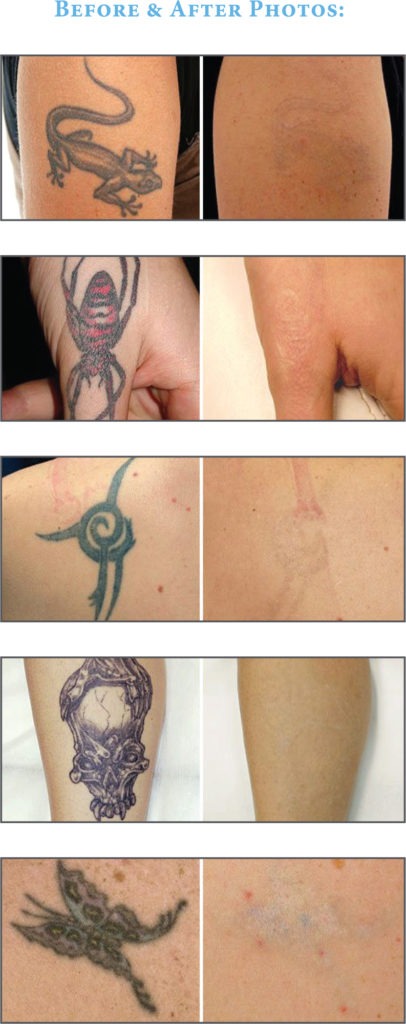 laser tattoo removal before and after photos