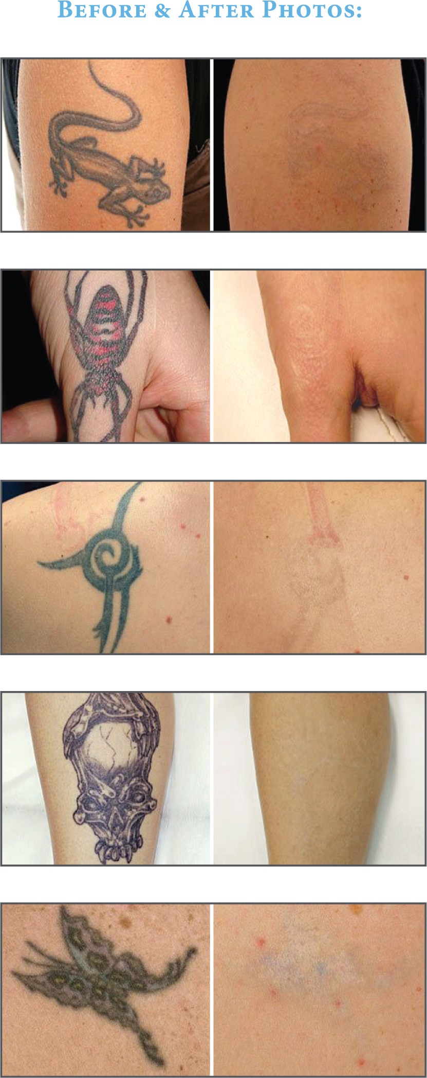 Best Laser Tattoo Removal in Santa Barbara, CA | The G Spa