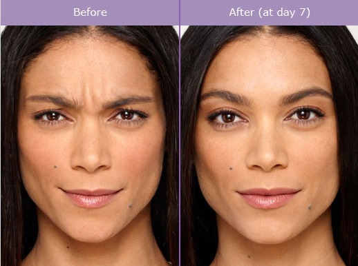 The Definitive Guide to Rha Collection Dermal Fillers Los Angeles thumbnail
