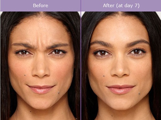 Examine This Report on Botox & Dermal Filler Training Los Angeles, California thumbnail