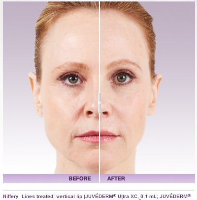  Your Woodland Hills Area Juvederm Med Spa 