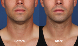 Now Offering Kybella Injections for Chin Fat Reduction | Encino | LA