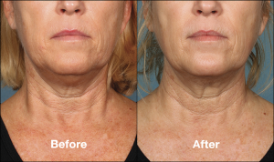 Kybella | Chin Fat Reduction | FDA Approved | Calabasas | Med Spa 