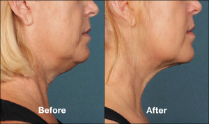 Kybella Injections for Chin Fat Reduction Cost | Encino | Calabasas