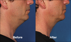 Kybella Injections for Chin Fat Reduction Before and After | Encino