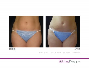 UltraShape Body Contouring Outstanding Before and After Photos