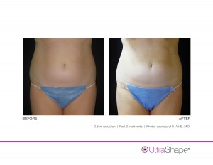 UltraShape-3.8cm-AdEl