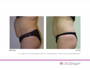 UltraShape Body Contouring Outstanding Before and After Photos