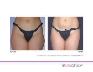 UltraShape-5cm-MorenoMoraga