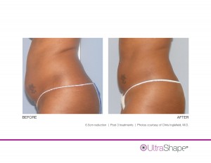 UltraShape-6.5cm-Inglefield