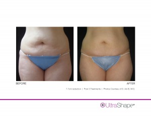 UltraShape Body Contouring Outstanding Before and After Photos