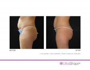 UltraShape Body Contouring Outstanding Before and After Photos