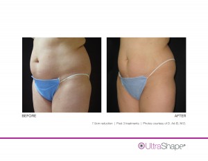 VelaShape III Before and After Photos | Medical Spa | Calabasas Encino