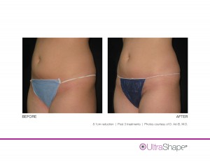 UltraShape - Los Angeles California Medical Spa