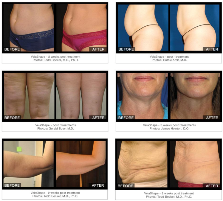 Body contouring, Cellulite reduction & inch loss - Surrey Beauty Therapy