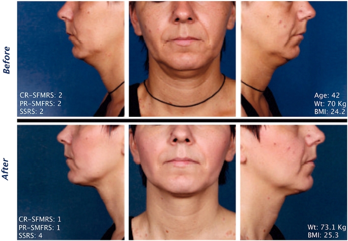 Kybella Injections for Double Chin Reduction Before & After Picture