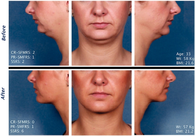 Kybella Injections for Double Chin Reduction Before & After Picture