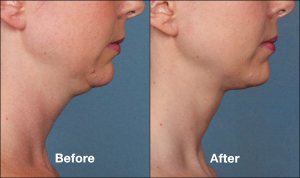  Non-Invasive Kybella May Improve Your Neckline | Encino | Calabasas