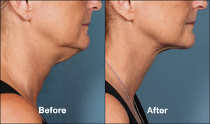 Kybella | Non-Surgical Chin Fat Reduction | Medical Spa | Encino