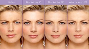 Botulinum Toxin (Botox) Procedure Steps | Los Angeles Med Spa