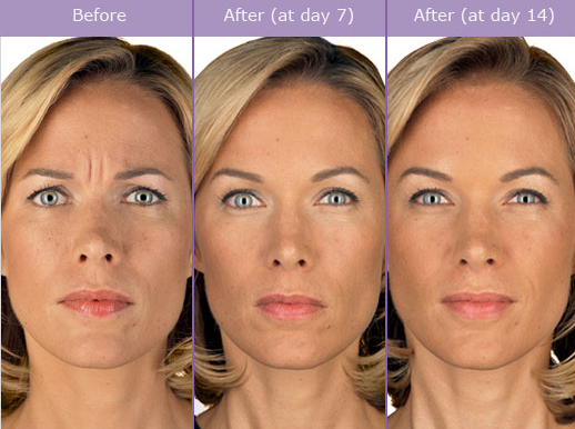 How long does Botox last? | Los Angeles Med Spa - Los Angeles California  Medical Spa