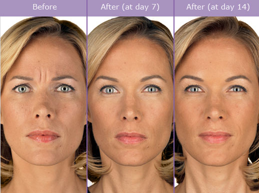 Not known Incorrect Statements About Botox Dentistry Los Angeles, Ca  thumbnail