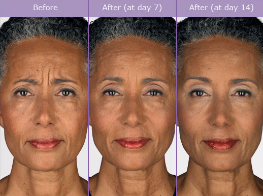 The smart Trick of Botox - Beverly Grove Los Angeles, Ca & Walnut, Ca That Nobody is Discussing thumbnail