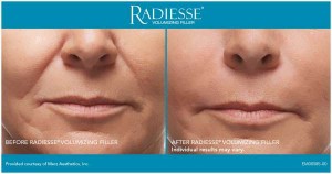 What are dermal filler injections like Radiesse? | Los Angeles Med Spa