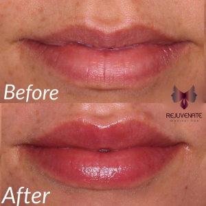 juvederm vollure before and after