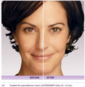 Juvederm Vollure Dermal Filler Before And After Photos | Calabasas