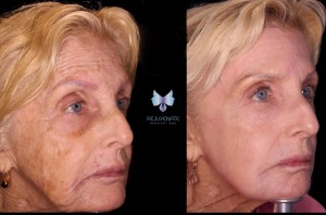 J Plasma Skin Tightening - Facelift Alternative