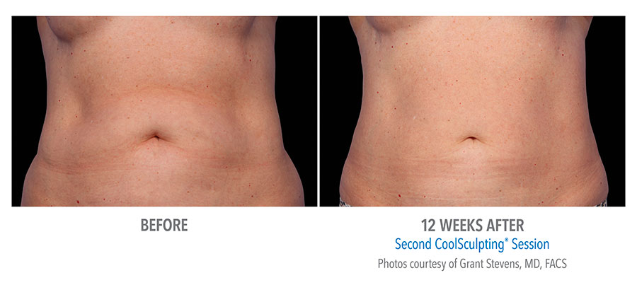 Body Contouring/Cellulite Reduction - Perfect Image Medical Spa