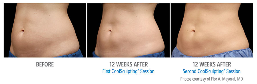 CoolSculpting for Fat Removal  La Nouvelle Medical Spa, Oxnard, Ventura