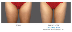 Coolsculpting 2025 thigh gap