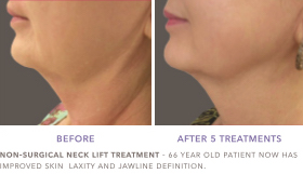 Skin tightening Neck