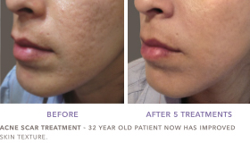Stretch Marks Reduction With The New RF Microneedling | Los Angeles