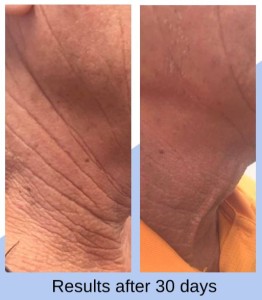 Neck Lift at Rejuvenate Medical Spa in Encino, CA