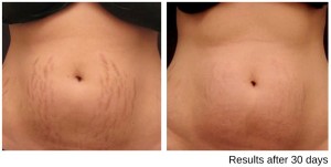 Stretch Mark Reduction at Rejuvenate Medical Spa in Encino, CA