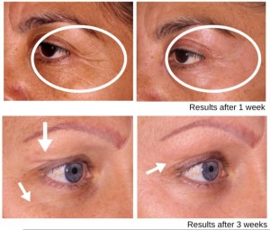 Eyelid Lift at Rejuvenate Medical Spa in Encino, CA