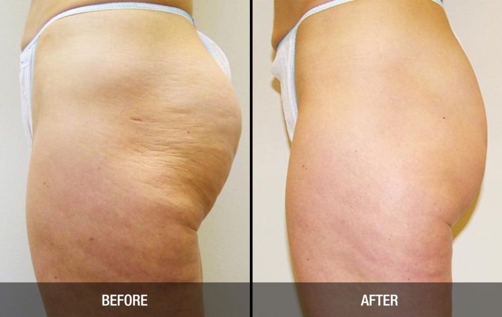 Cellulite Reduction Treatment Before And After Photos